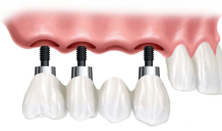 Dental Implants in process